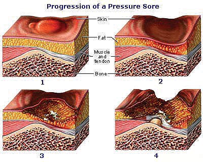 How to spot a Pressure Ulcer before it becomes a Serious Problem