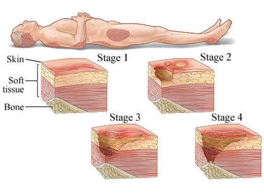 The Risk of Developing a Pressure Ulcer